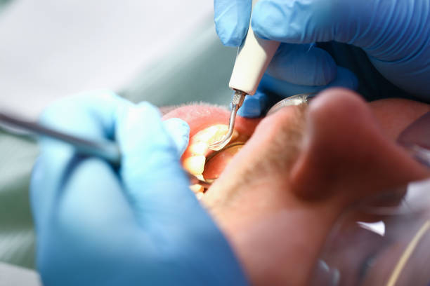 Best Emergency Dental Care for Abscessed Tooth in Clifton Forge, VA